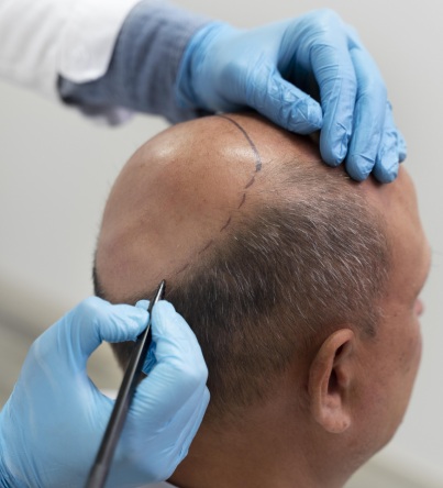 hair transplant treatment