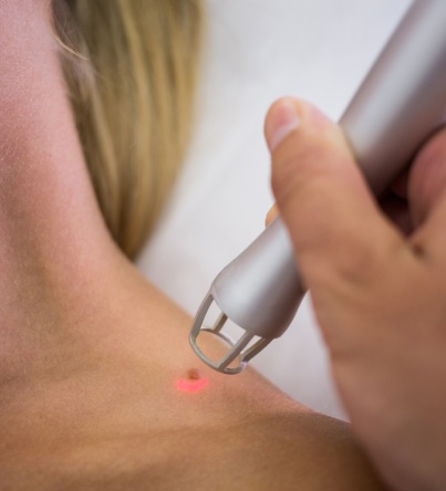 laser skin treatment