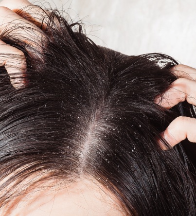 hair dandruff treatment